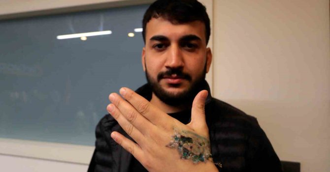 Dövme sildirmek isterken kabusu yaşadı, elindeki dokular öldü