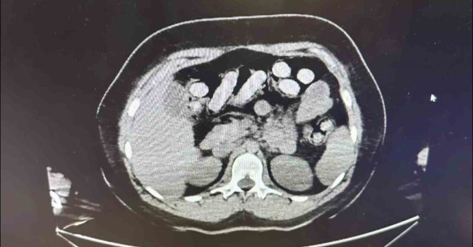 1.5 kilo metamfetamin iki kadın kuryenin bağırsak ve midesinden çıktı