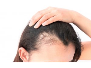 Saçınız günde 100 tel dökülüyorsa dikkat