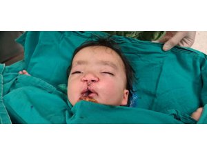 Yarık damak ve dudaklı bebeğe "Türk lalesi" ameliyatı