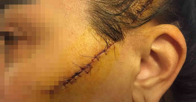 Eski sevgilisinin yüzünü usturayla kesen adam tutuklandı