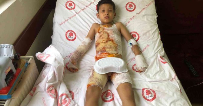 Anaokulunda üzerine sıcak su dökülen çocuk tedavi altına alındı