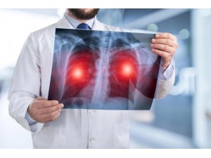 Sigara içenlerde risk 25 kat artıyor