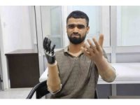 Demirin elektrik tellerine değmesiyle hayatı kararan Muhammed, 3 milyon TL değerindeki protez bacağına ve 2 biyonik koluna kavuştu