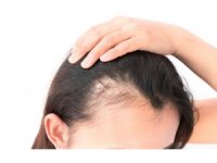 Saçınız günde 100 tel dökülüyorsa dikkat