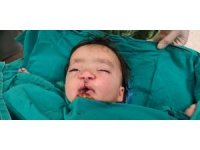 Yarık damak ve dudaklı bebeğe "Türk lalesi" ameliyatı