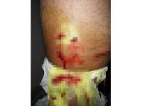 Yürüyüş yaparken sokak köpeklerinin saldırısına uğradı