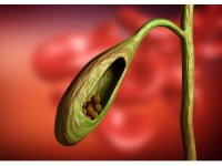 Safra kesesi taşını mide ağrısı ile karıştırmayın