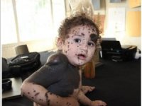 Vücudunda leke ve kitle ile doğan bebek tedavi ediliyor