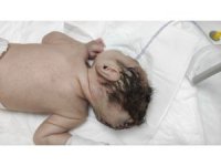 Beyninin yarısı kafatası dışında dünyaya geldi