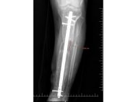 İş kazası geçiren hastaya boy uzatma ameliyatı yapıldı