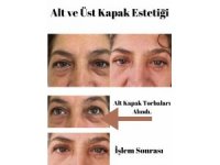 Elmalı Devlet Hastanesi’nde göz kapağı estetik ameliyatları başladı