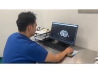 Osmaniye’de ilk kez kapalı ameliyatla böbrek tümörü başarıyla alındı